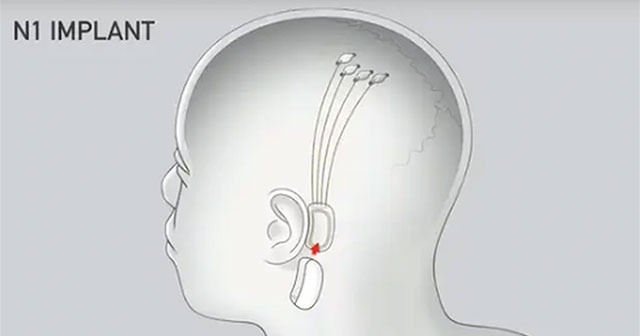 Hàng triệu người háo hức tham gia thử nghiệm cấy chip não của Neuralink