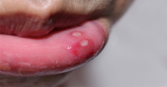 Tìm Hiểu Về Nhiệt Miệng: Nguyên Nhân, Triệu Chứng Và Hướng Điều Trị Hiệu Quả