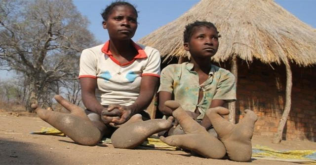Người Vadoma ở thung lũng Zambezi: chân hai ngón, lối sống và những hệ lụy văn hóa
