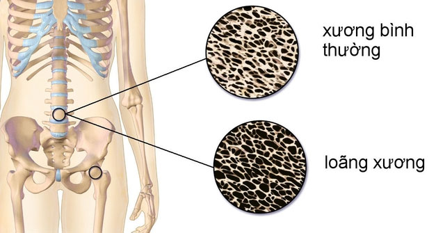 4 nhóm thực phẩm âm thầm làm thất thoát canxi và cách ứng xử hợp lý