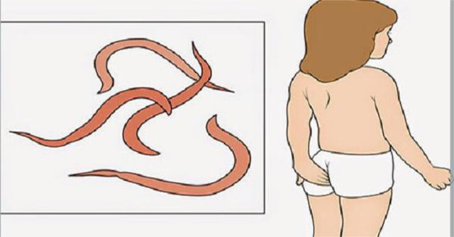 Khi trẻ ngứa hậu môn: hướng dẫn an toàn để bắt giun kim tại nhà